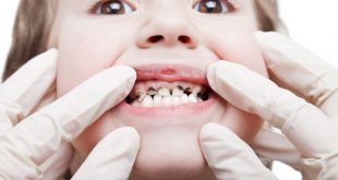 Потъмняване и кариес на млечните зъбки при децата